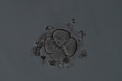 IVF, In Vitro Fertilization