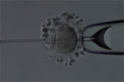 ICSI - Intracytoplasmic Sperm Injection